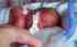 Read more about What constitutes a medical reason for preterm birth?